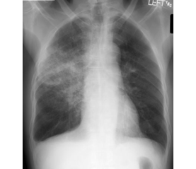 ChestXray